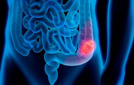 78802-campania-de-prevencion-del-cancer-de-colon-en-el-hospital-senior-del-milagro