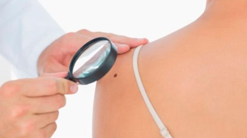 lunares-cancer-de-piel-campaña-prevencion-cordoba