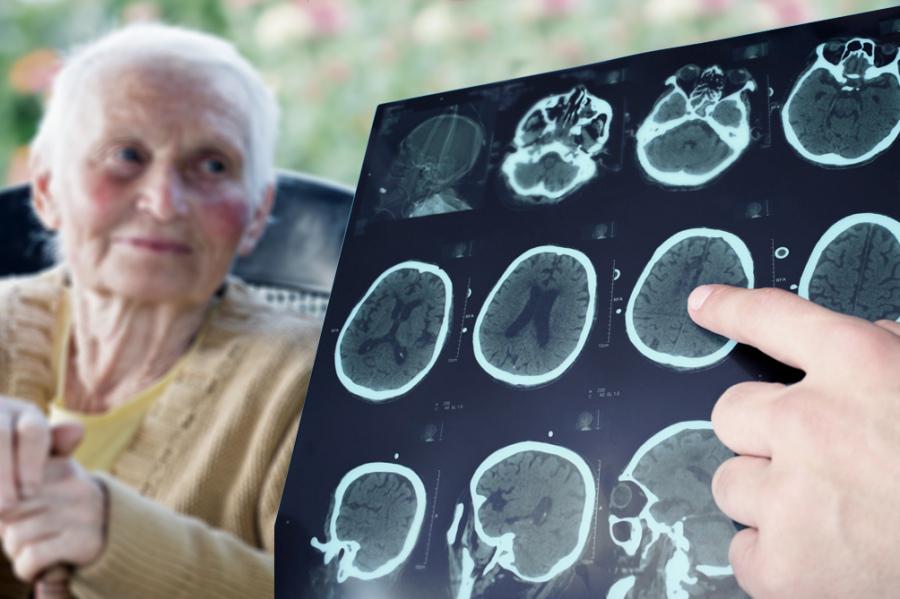 alzheimer